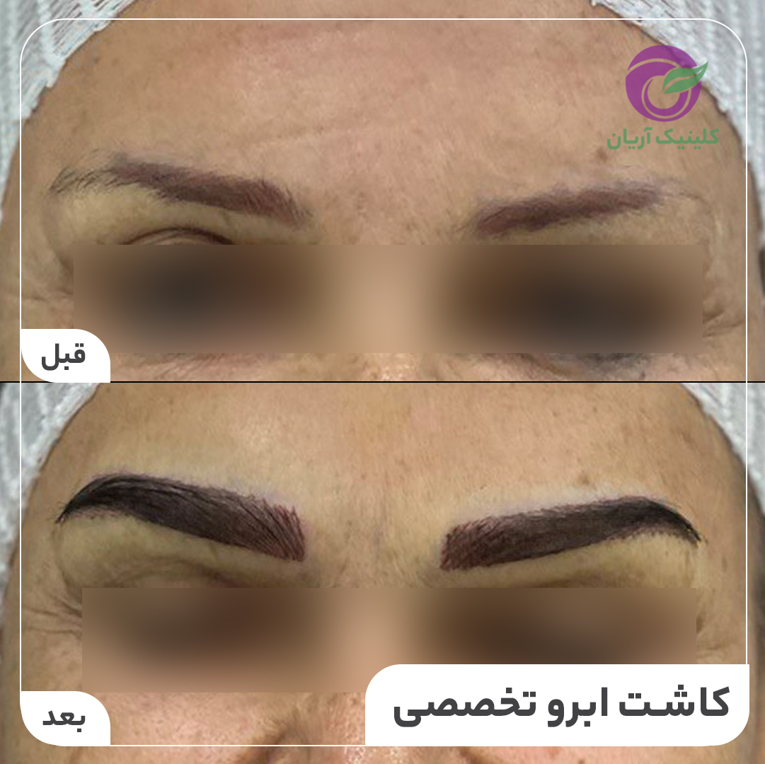 گالری فیلم کاشت ابرو